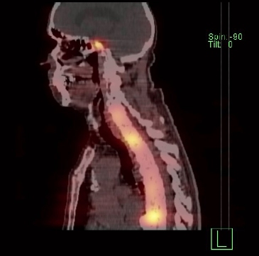 Obr. č. 5: SPECT/CT za 4 hod. po aplikaci OctreoScanu.