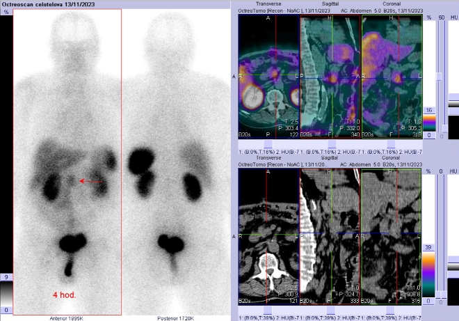 Obr.1: Celotělová scintigrafie a SPECT/CT za 4 hod. po aplikaci OctreoScanu.