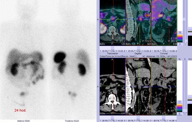 Obr..2: Celotlov scintigrafie a SPECT/CT za 4 hod. po aplikaci OctreoScanu.