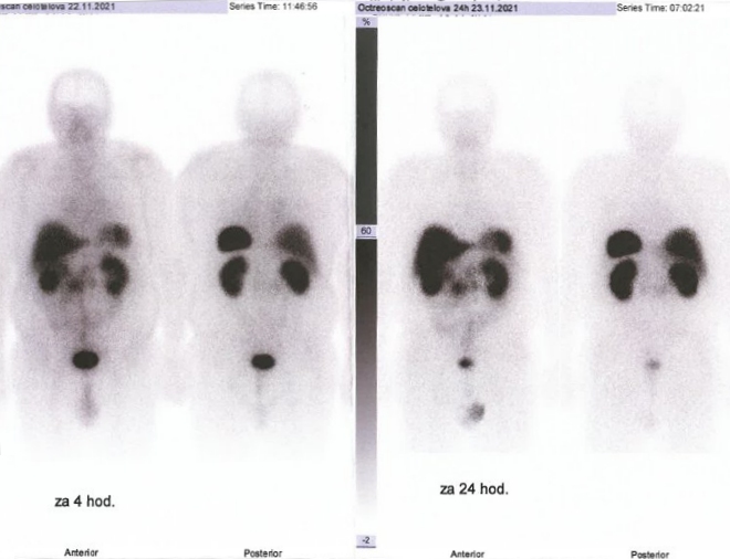 Obr. č. 1: Celotělová scintigrafie 4 a 24 hod. po aplikaci OctreoScanu.
