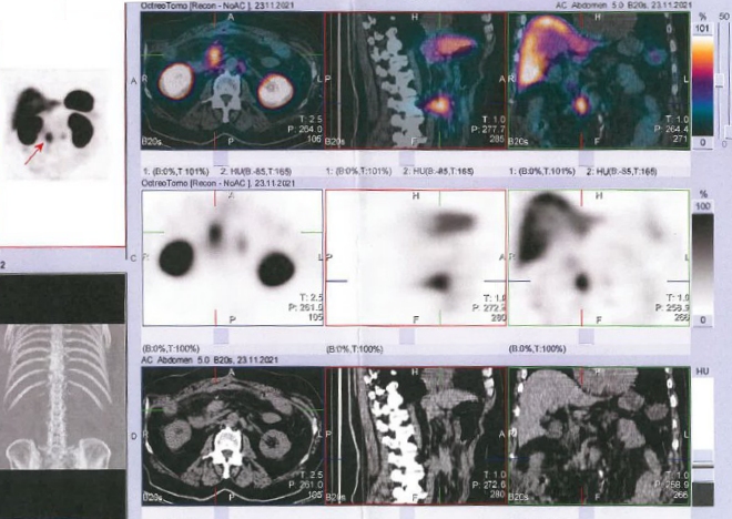 Obr. č. 2: Fúze SPECT/CT břicha a pánve 24 hod. po aplikaci OctreoScanu.
