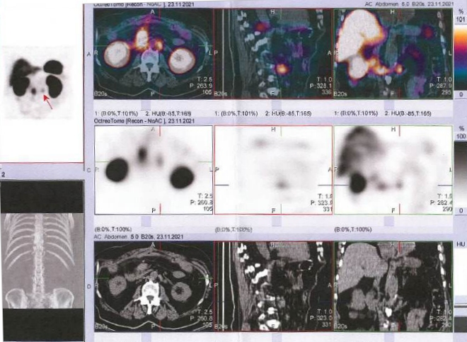 Obr. č. 3: Fúze SPECT/CT břicha a pánve 24 hod. po aplikaci OctreoScanu.