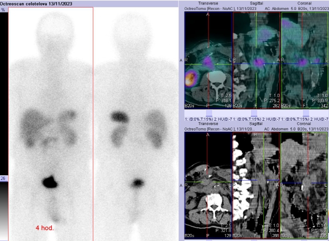 Obr. č. 4: Celotělová scintigrafie a fúze SPECT/CT břicha a pánve 4 hod. po aplikaci OctreoScanu.