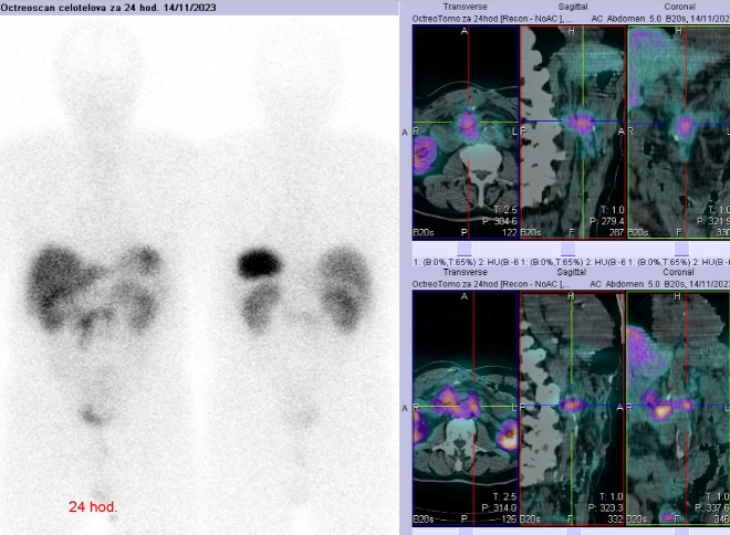 Obr. č. 5: Celotělová scintigrafie a fúze SPECT/CT břicha a pánve 24 hod. po aplikaci OctreoScanu.