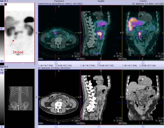 Obr. č. 6: Fúze SPECT/CT břicha a pánve 24 hod. po aplikaci OctreoScanu.