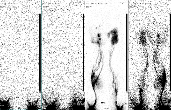Obr.1: Celotlov scintigrafie  vyeten v klidu a po zti.
