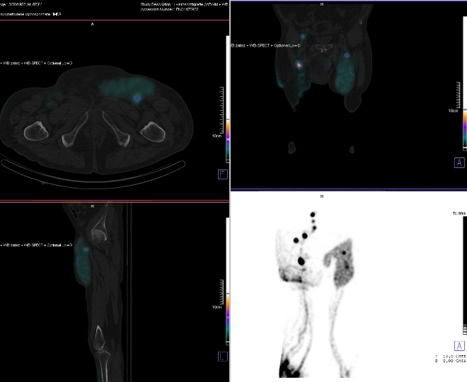 Obr..2: SPECT/CT