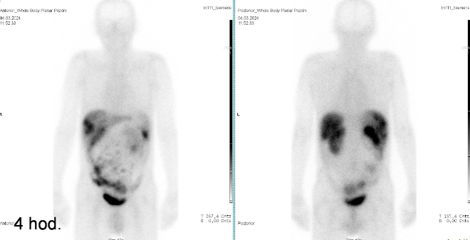 Obr. �. 1: Celot�lov� scintigrafie 4 hod. po aplikaci OctreoScanu.