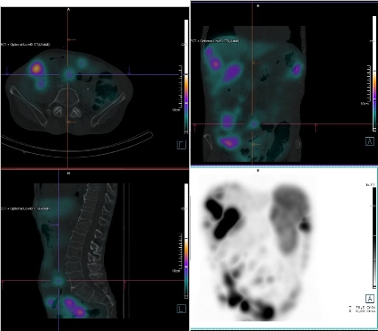 Obr. �. 11: F�ze SPECT/CT b�icha a p�nve 24 hod. po aplikaci OctreoScanu.