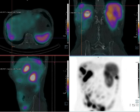 Obr.�.2: F�ze SPECT/CT b�icha a p�nve 4 hod. po aplikaci OctreoScanu.