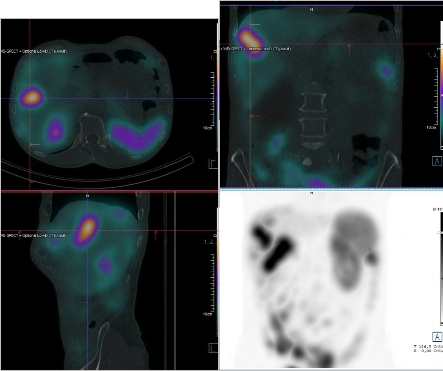 Obr. �. 4: F�ze SPECT/CT b�icha a p�nve 4 hod. po aplikaci OctreoScanu.