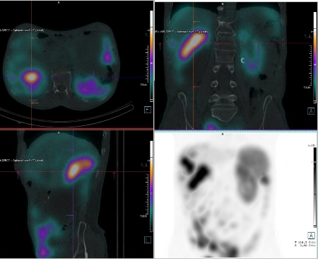 Obr. �. 5: F�ze SPECT/CT b�icha a p�nve 4 hod. po aplikaci OctreoScanu.