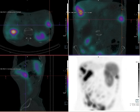 Obr. �. 6: F�ze SPECT/CT b�icha a p�nve 4 hod. po aplikaci OctreoScanu.