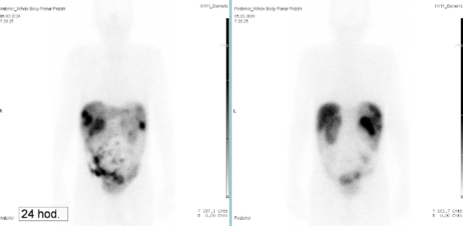 Obr. �. 7: Celot�lov� scintigrafie 24 hod. po aplikaci OctreoScanu.