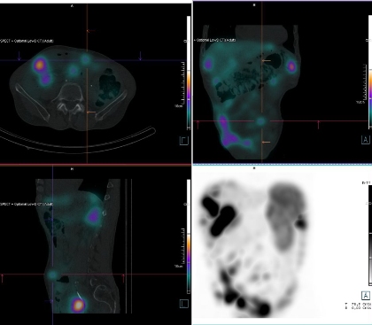 Obr. �. 8: F�ze SPECT/CT b�icha a p�nve 24 hod. po aplikaci OctreoScanu.