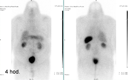 Obr. �. 3: Celot�lov� scintigrafie v p�edn� a zadn� projekci 4 hod. po aplikaci OctreoScanu.
