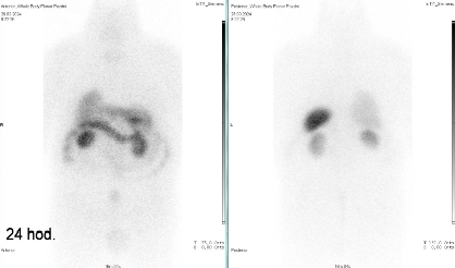 Obr. �. 6: Celot�lov� scintigrafie v p�edn� a zadn� projekci 24 hod. po aplikaci OctreoScanu.