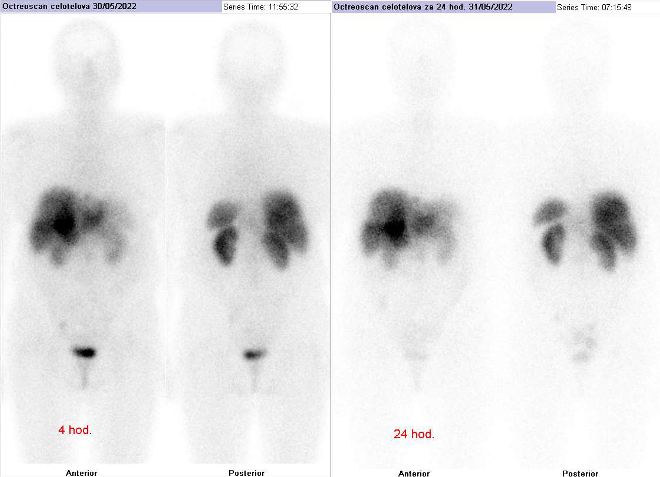 Obr. �. 1: Celot�lov� scintigrafie v p�edn� a zadn� projekci 4 (vlevo) a 24 hod. (vpravo) po aplikaci OctreoScanu.