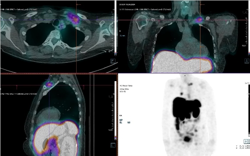 Obr. �. 10: F�ze SPECT/CT 24 hod. po aplikaci OctreoScanu.