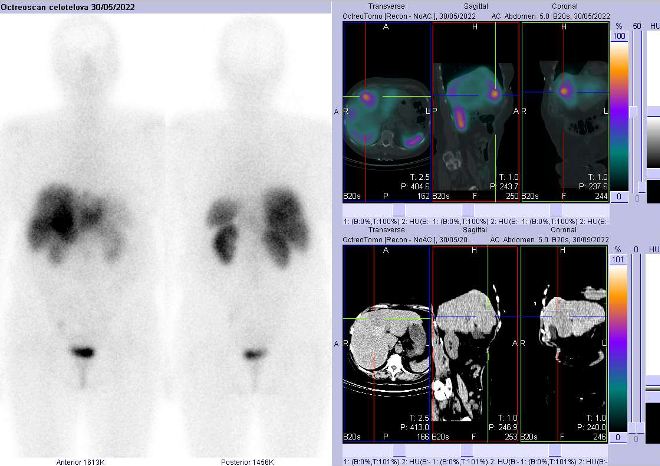 Obr.�.2: Celot�lov� scintigrafie a f�ze SPECT/CT 4 hod. po aplikaci OctreoScanu. Zam��eno na prav� jatern� lalok s lo�iskem.