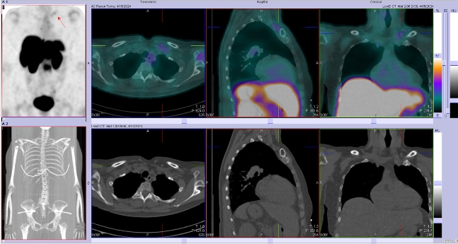 Obr. �. 3: F�ze SPECT/CT 4 hod. po aplikaci OctreoScanu.