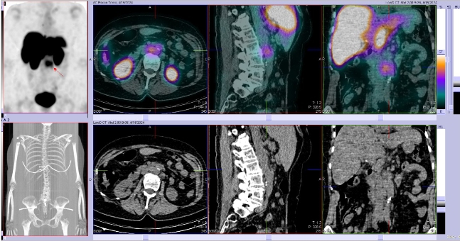 Obr. �. 4: F�ze SPECT/CT 4 hod. po aplikaci OctreoScanu.