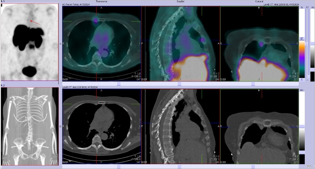 Obr. �. 5: F�ze SPECT/CT 4 hod. po aplikaci OctreoScanu.