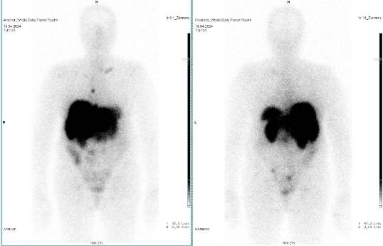 Obr. �. 6: Celot�lov� scintigrafie v p�edn� a zadn� projekci 24 hod.  po aplikaci OctreoScanu.
