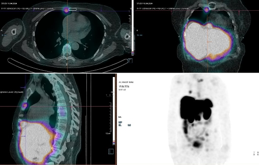 Obr. �. 7: F�ze SPECT/CT 4 hod. po aplikaci OctreoScanu.