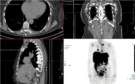 Obr. �. 8: F�ze SPECT/CT 24 hod. po aplikaci OctreoScanu.