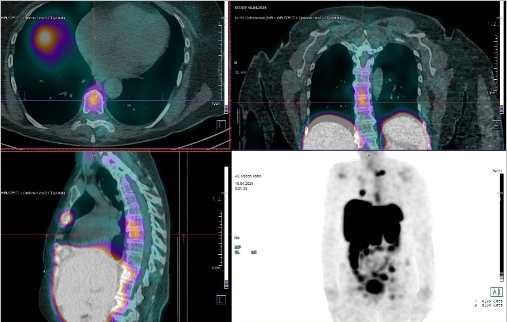 Obr. �. 9: F�ze SPECT/CT 24 hod. po aplikaci OctreoScanu.
