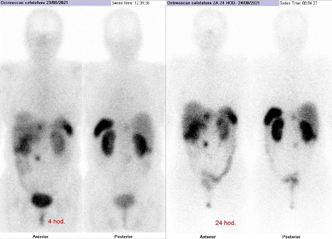 Obr. �. 1: Celot�lov� scintigrafie v p�edn� a zadn� projekci za 4 a 24 hod. po aplikaci OctreoScanu.