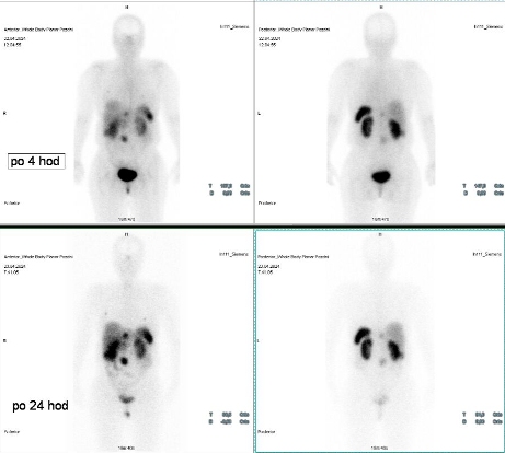 Obr. �. 2: Celot�lov� scintigrafie v p�edn� a zadn� projekci za 4 a 24 hod. po aplikaci OctreoScanu.