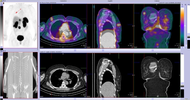 Obr. �. 3: F�ze SPECT/CT 4 hod. po aplikaci OctreoScanu.