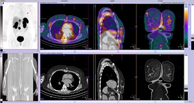 Obr. �. 4: F�ze SPECT/CT 4 hod. po aplikaci OctreoScanu.
