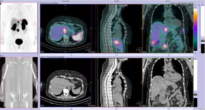 Obr. �. 5: F�ze SPECT/CT 4 hod. po aplikaci OctreoScanu.