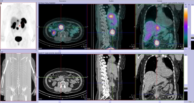 Obr. �. 6: F�ze SPECT/CT 4 hod. po aplikaci OctreoScanu.