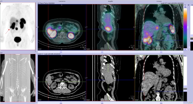 Obr. �. 7: F�ze SPECT/CT 4 hod. po aplikaci OctreoScanu.