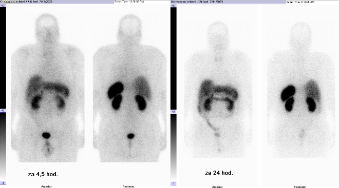 Obr. �. 1: Celot�lov� scintigrafie v p�edn� a zadn� projekci 4 a 24 hod. po aplikaci OctreoScanu.