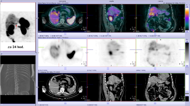Obr. č. 2: Fúze SPECT/CT břicha a pánve 24 hod. po aplikaci OctreoScanu. Zaměřeno na ložisko v proximální části duodena.