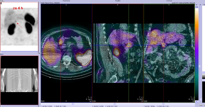 Obr. č. 4: Fúze SPECT/CT břicha a pánve 4 hod. po aplikaci OctreoScanu. Zaměřeno na ložisko v proximální části duodena.