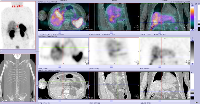 Obr. č. 6: Fúze SPECT/CT břicha a pánve 24 hod. po aplikaci OctreoScanu. Zaměřeno na ložisko v proximální části duodena.