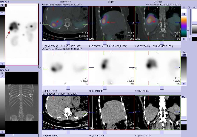 Obr.č.2: Fúze obrazů SPECT a CT. Vyšetření 5 hod. po aplikaci radioindikátoru. Zaměřeno na ložisko v dorzální části pravého jaterního laloku.
