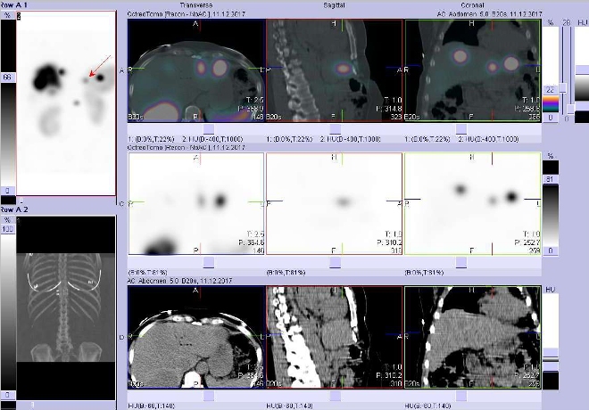 Obr. č. 3: Fúze obrazů SPECT a CT. Vyšetření 5 hod. po aplikaci radioindikátoru. Zaměřeno na ložisko ve ventrální části levého jaterního laloku.