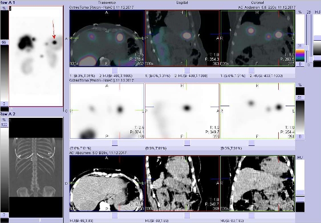 Obr. č. 4: Fúze obrazů SPECT a CT. Vyšetření 5 hod. po aplikaci radioindikátoru. Zaměřeno na ložisko ve ventrální části levého jaterního laloku.