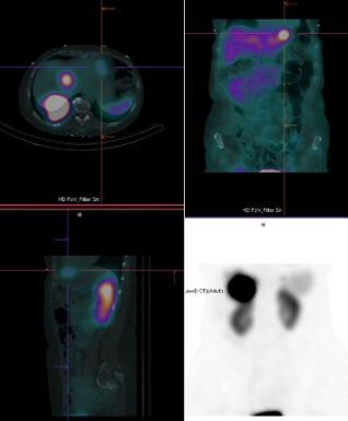 Obr. č. 6-7: CT a fúze obrazů SPECT a CT. Vyšetření 4 hod. po aplikaci radioindikátoru. Zaměřeno na ložiska v játrech.