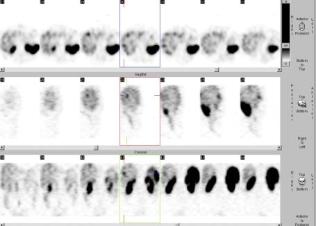Obr. č. 4: Tomografická scintigrafie břicha a pánve 24 hod. po aplikaci OctreoScanu. Zaměřeno na okrouhlé ložisko v laterální části pravého jaterního laloku
