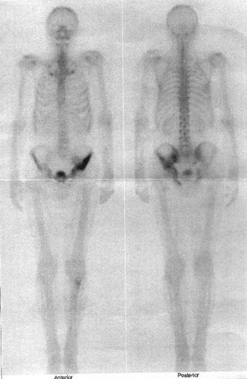 Obr. č. 1: Celotělová scintigrafie skeletu v přední a zadní projekci