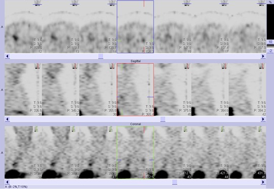 Obr.č.4: Tomografická scintigrafie hrudníku 24 hod. po aplikaci OctreoScanu