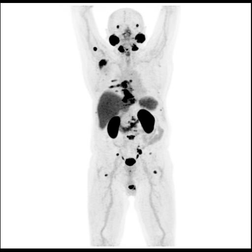 Obr. 1: 3D PET MIP rekonstrukce. Lo�iska patologicky zv��en� akumulace 18F-piflufolastatu ve skeletu.